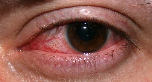 Fungal Keratitis