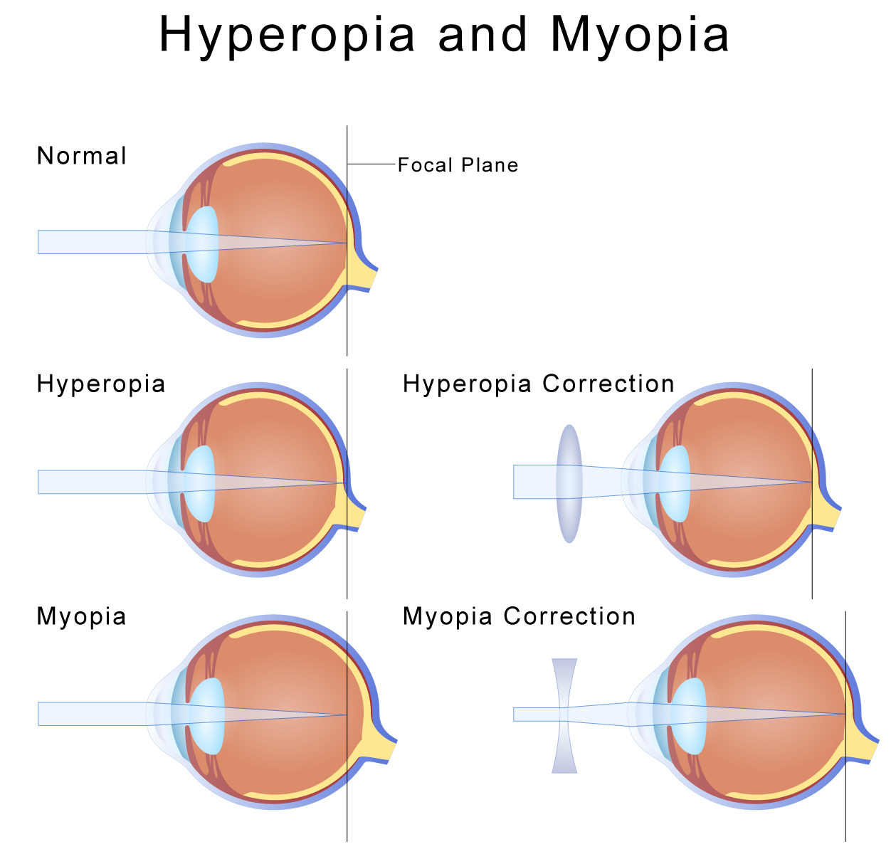 Myopia (nearsightedness) - what is it?