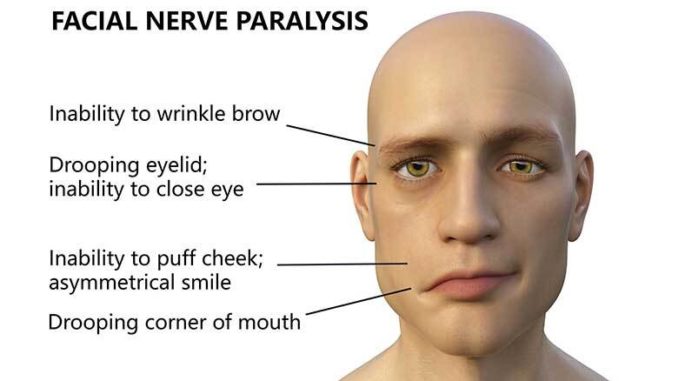 Bell's Palsy symptoms