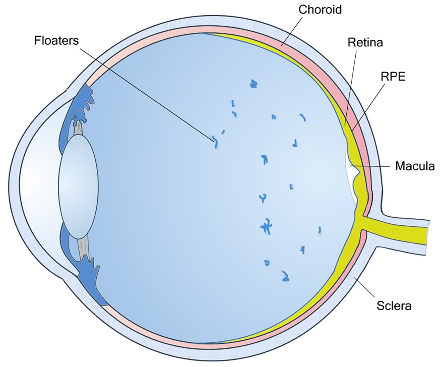 Eye Floaters